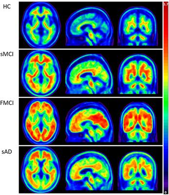 Tau PET With 18F-THK-5351 Taiwan Patients With Familial Alzheimer's Disease With the APP p.D678H Mutation